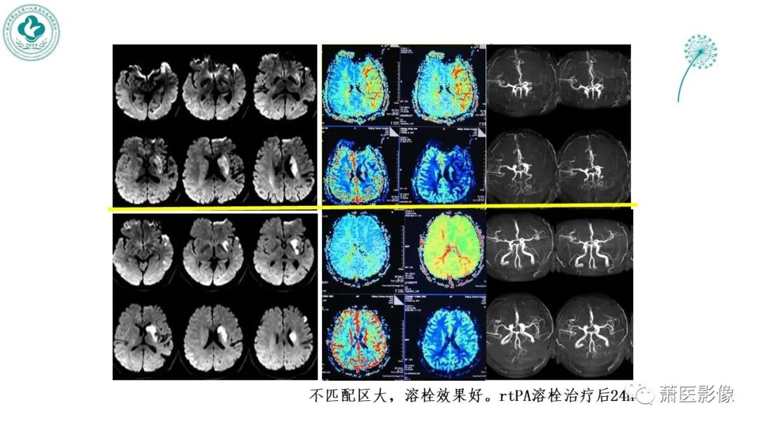 【PPT】脑灌注成像原理及在临床中的应用-34