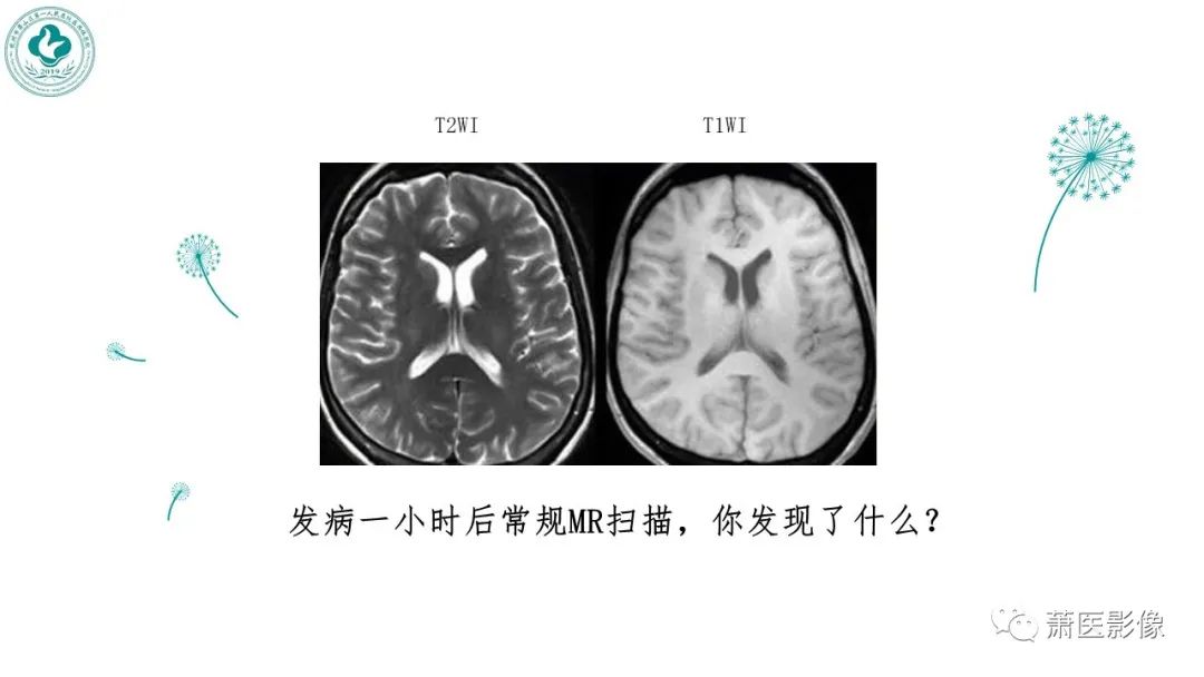 【PPT】脑灌注成像原理及在临床中的应用-36