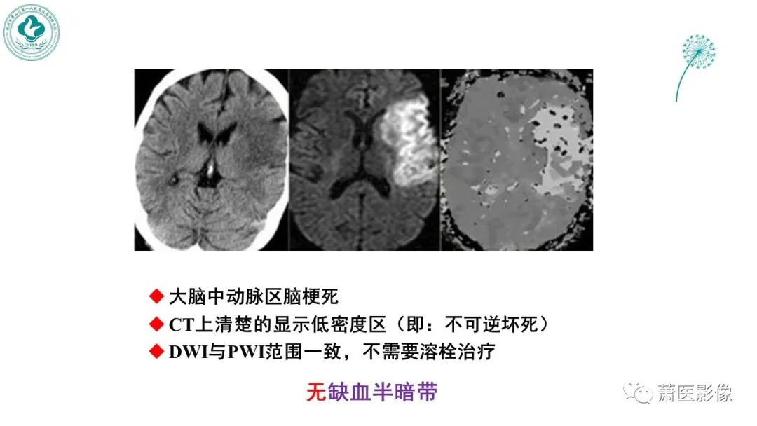 【PPT】脑灌注成像原理及在临床中的应用-38