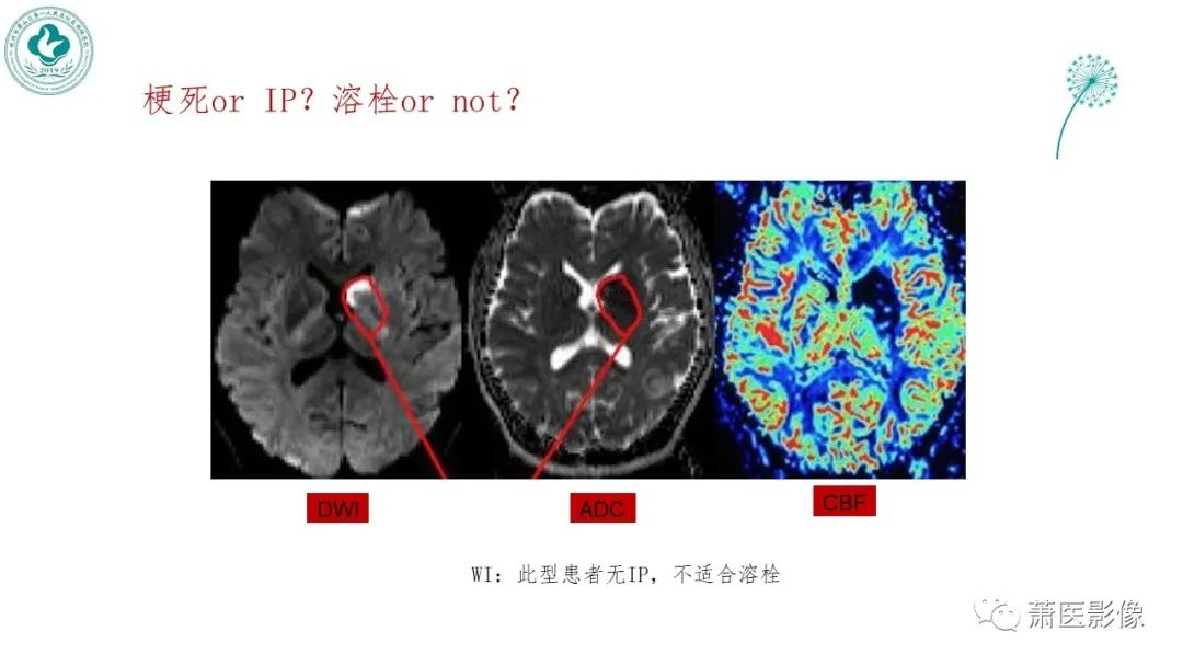 【PPT】脑灌注成像原理及在临床中的应用-39