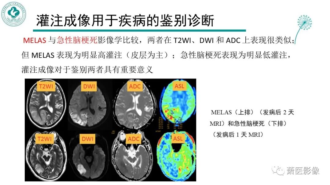 【PPT】脑灌注成像原理及在临床中的应用-41
