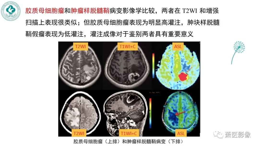 【PPT】脑灌注成像原理及在临床中的应用-42