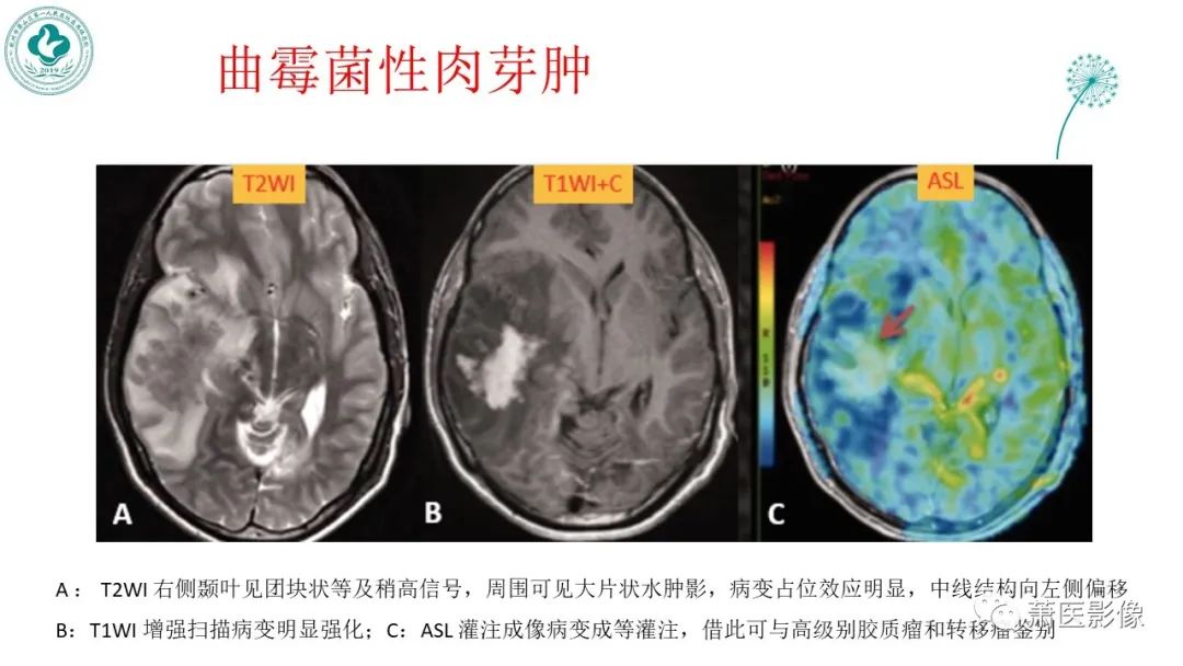 【PPT】脑灌注成像原理及在临床中的应用-43