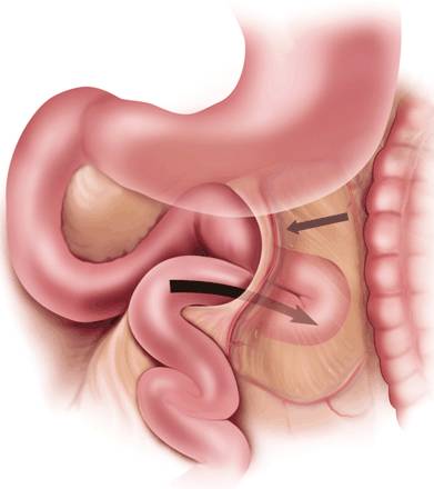 Treitz疝—十二指肠旁疝-2