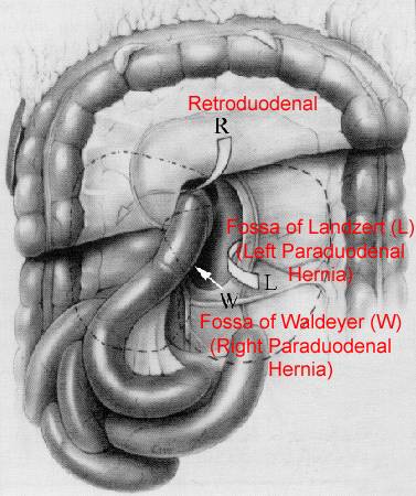 Treitz疝—十二指肠旁疝-1