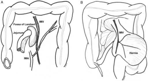 Treitz疝—十二指肠旁疝-3