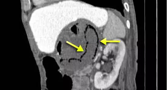 Treitz疝—十二指肠旁疝-5