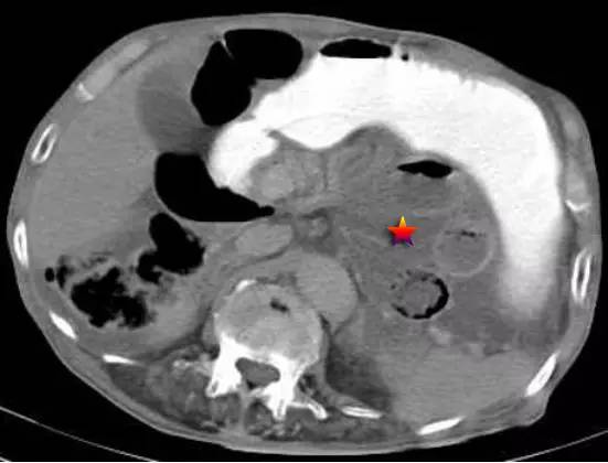 Treitz疝—十二指肠旁疝-4