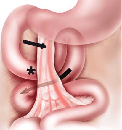 Treitz疝—十二指肠旁疝-6