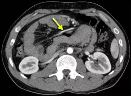 Treitz疝—十二指肠旁疝-7