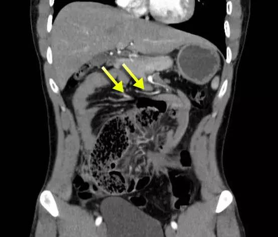 Treitz疝—十二指肠旁疝-8