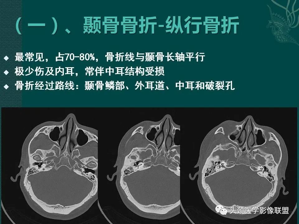 【PPT】耳部常见疾病影像表现-4