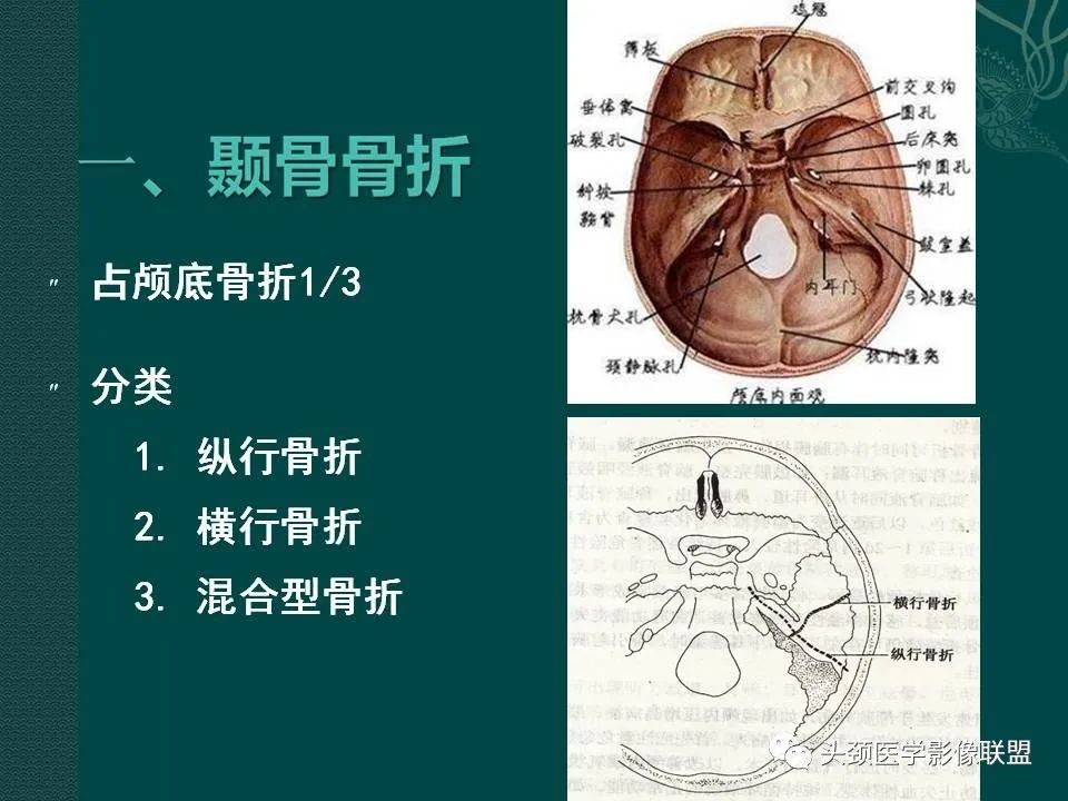 【PPT】耳部常见疾病影像表现-3