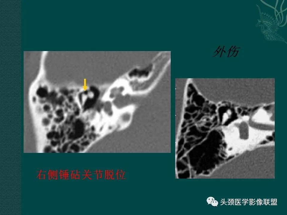 【PPT】耳部常见疾病影像表现-6