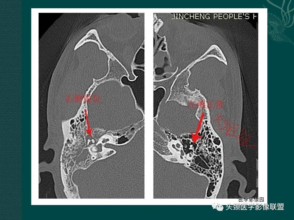 【PPT】耳部常见疾病影像表现-7