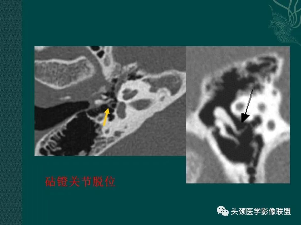 【PPT】耳部常见疾病影像表现-8