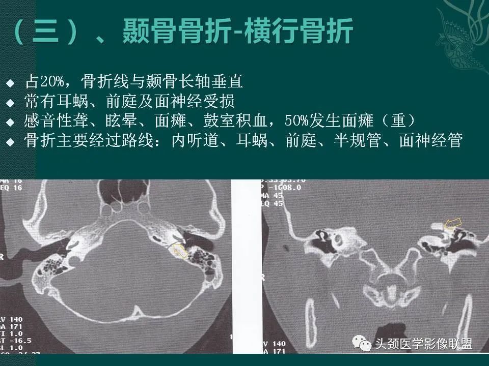 【PPT】耳部常见疾病影像表现-9