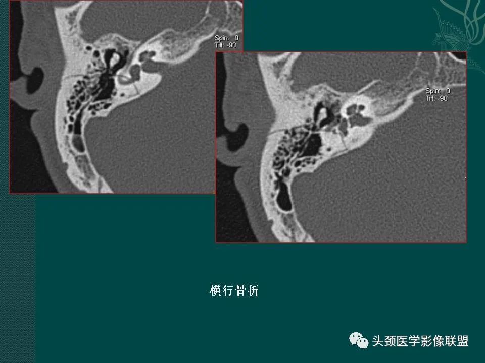 【PPT】耳部常见疾病影像表现-10