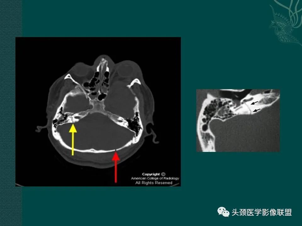 【PPT】耳部常见疾病影像表现-11