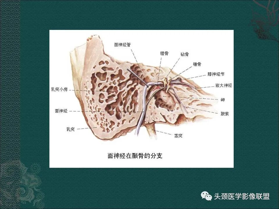 【PPT】耳部常见疾病影像表现-14