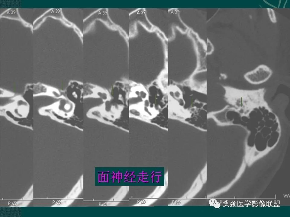 【PPT】耳部常见疾病影像表现-16