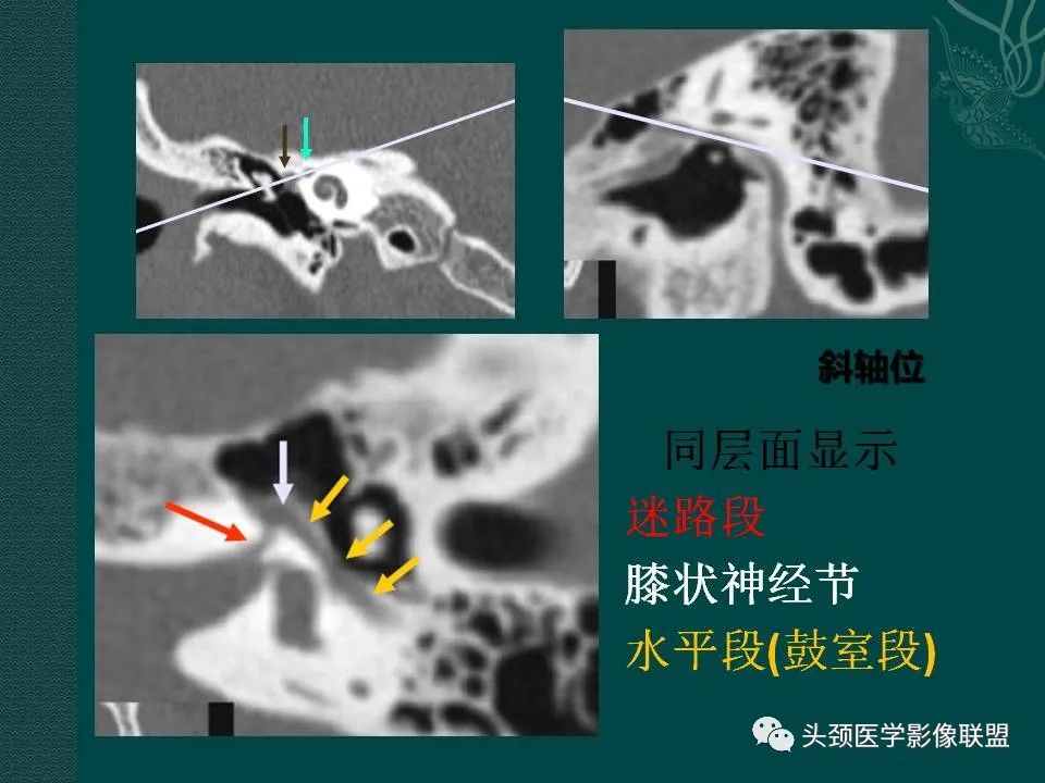 【PPT】耳部常见疾病影像表现-17