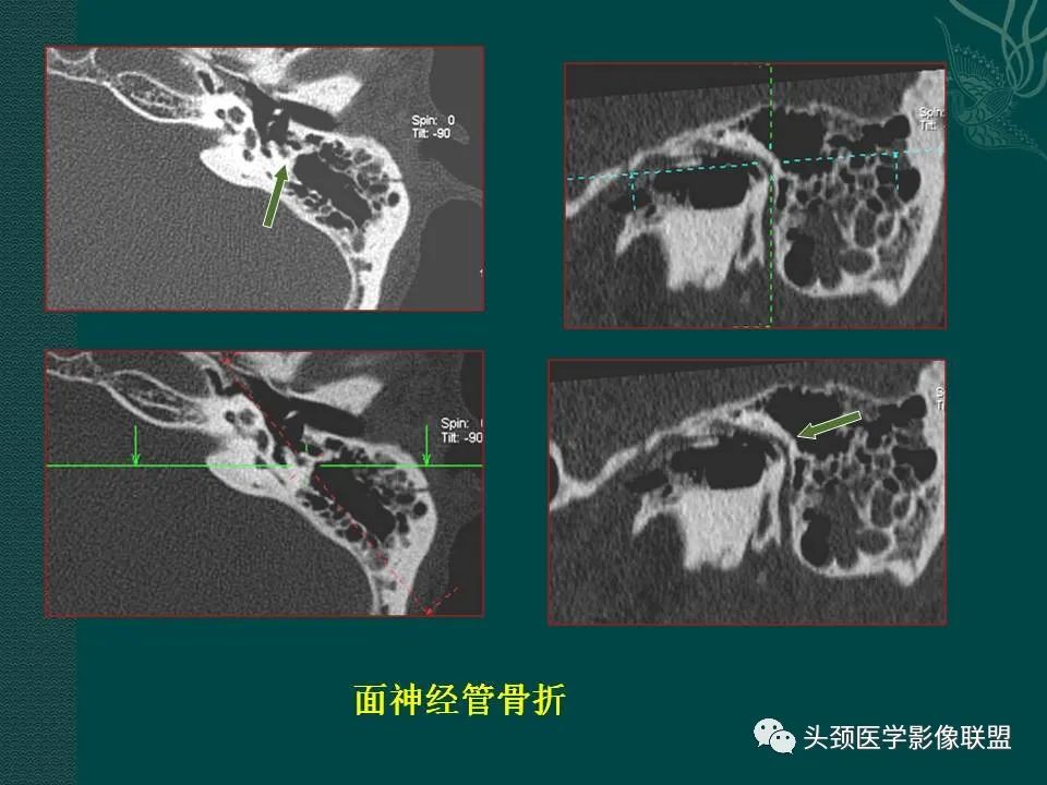 【PPT】耳部常见疾病影像表现-18