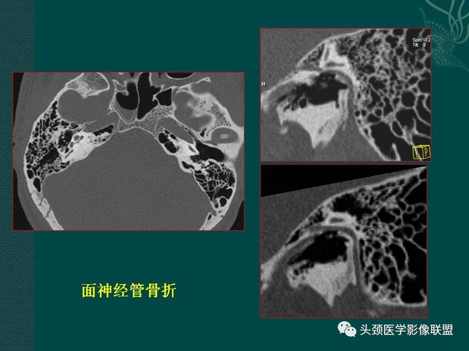 【PPT】耳部常见疾病影像表现-19