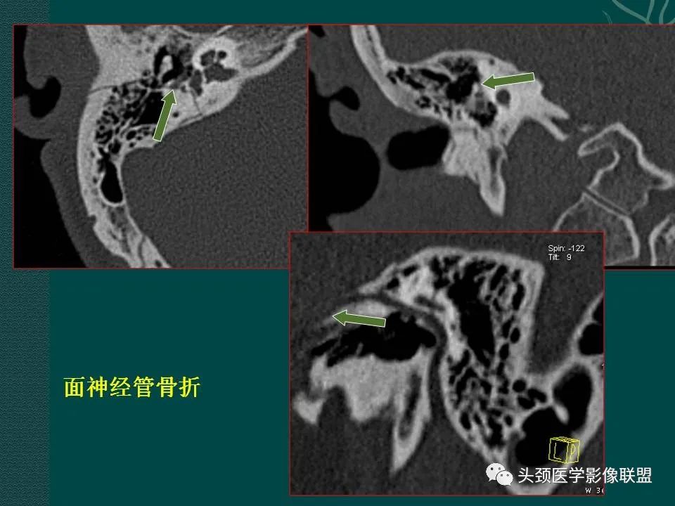 【PPT】耳部常见疾病影像表现-20