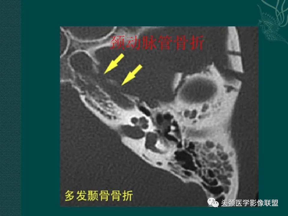 【PPT】耳部常见疾病影像表现-21
