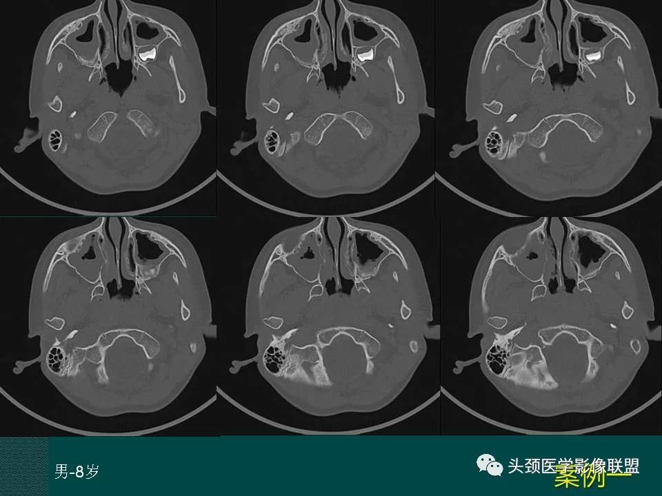 【PPT】耳部常见疾病影像表现-26