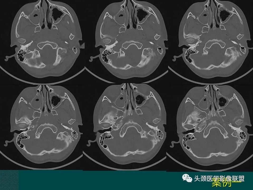 【PPT】耳部常见疾病影像表现-27