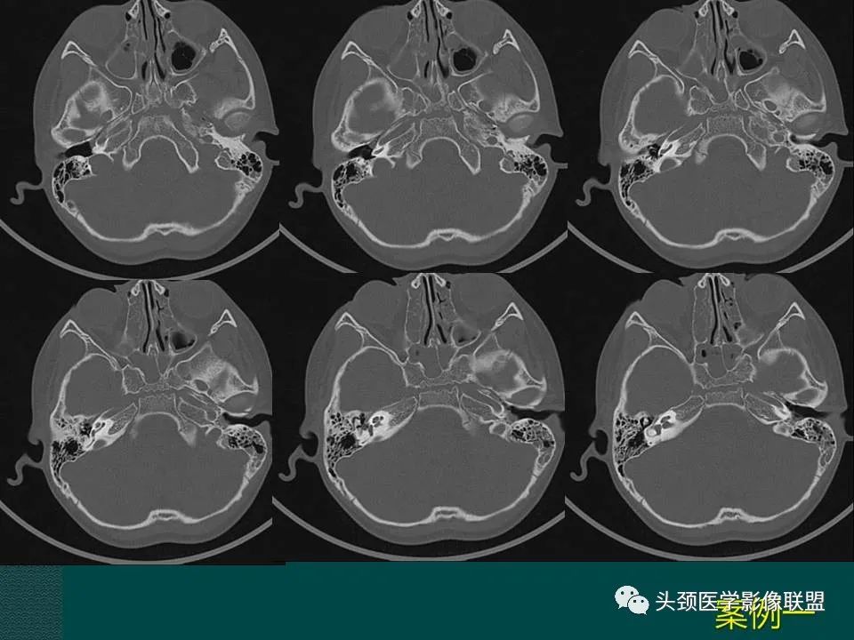【PPT】耳部常见疾病影像表现-28