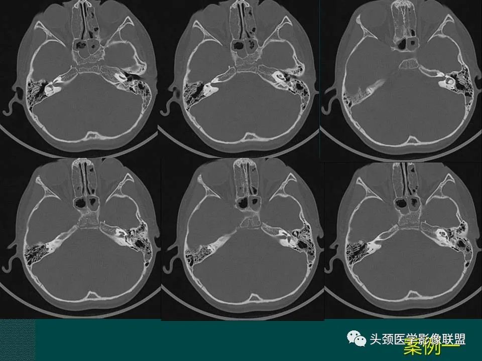 【PPT】耳部常见疾病影像表现-29
