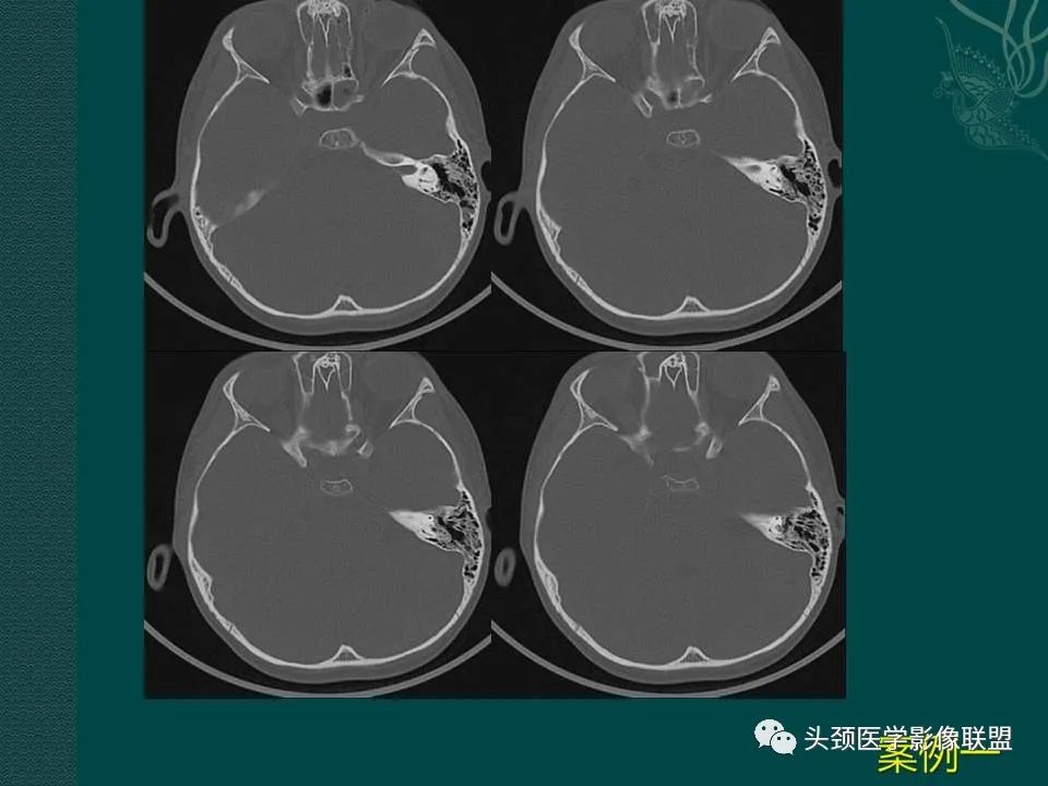 【PPT】耳部常见疾病影像表现-30