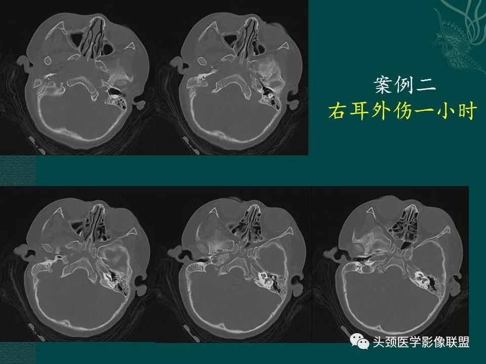 【PPT】耳部常见疾病影像表现-31