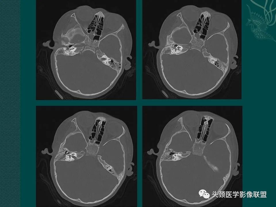 【PPT】耳部常见疾病影像表现-32