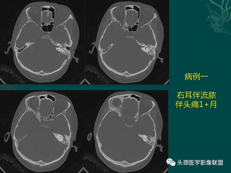 【PPT】耳部常见疾病影像表现-34