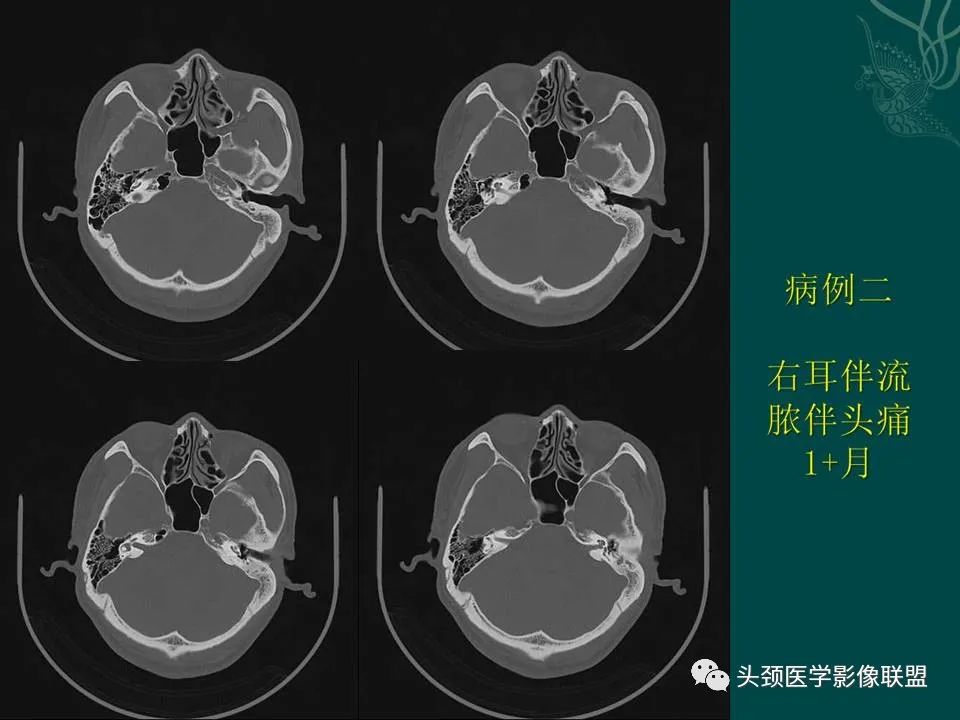 【PPT】耳部常见疾病影像表现-35