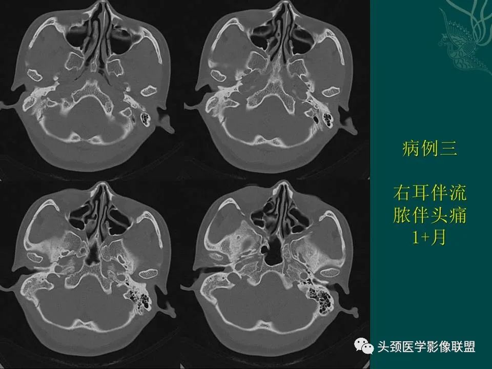 【PPT】耳部常见疾病影像表现-36