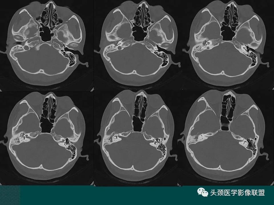 【PPT】耳部常见疾病影像表现-37