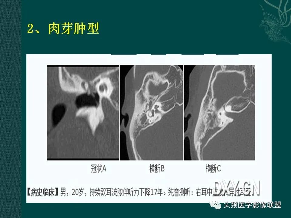 【PPT】耳部常见疾病影像表现-38