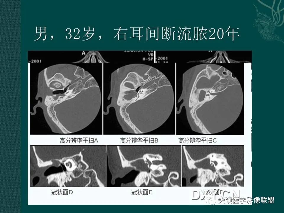 【PPT】耳部常见疾病影像表现-40