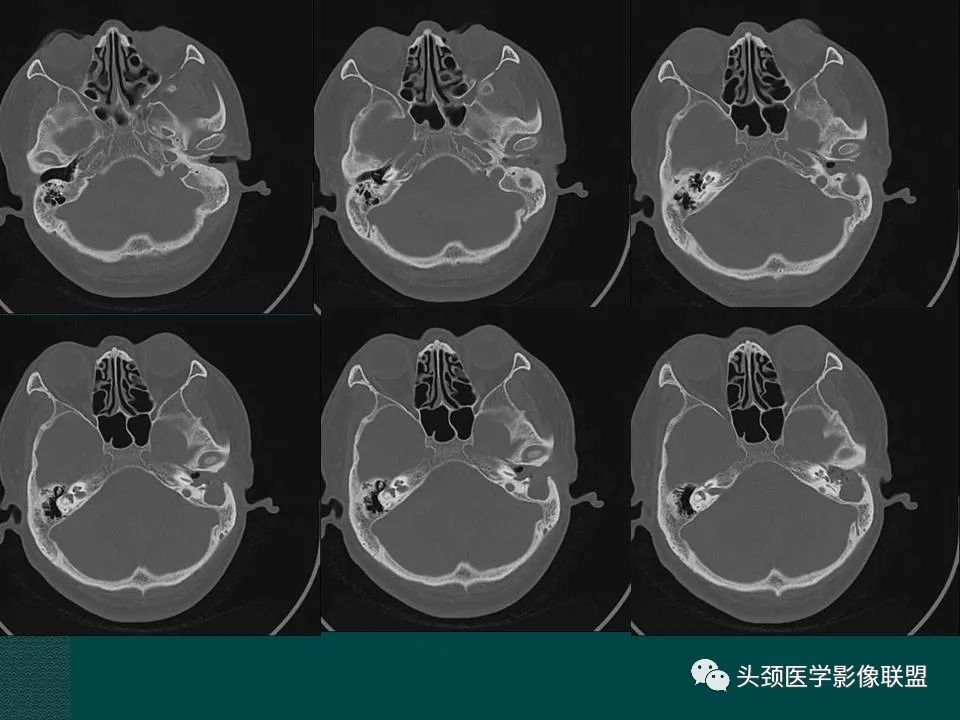 【PPT】耳部常见疾病影像表现-43