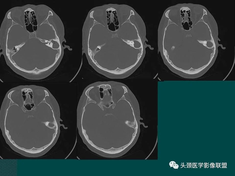 【PPT】耳部常见疾病影像表现-44