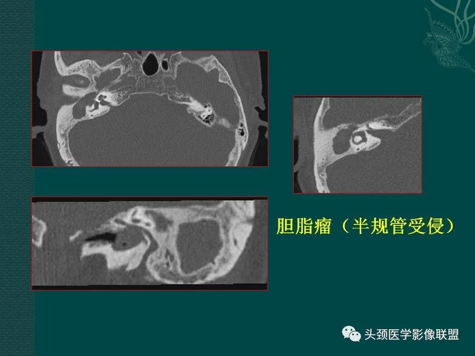 【PPT】耳部常见疾病影像表现-45