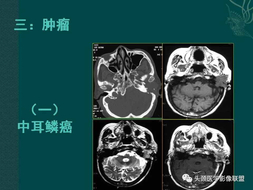 【PPT】耳部常见疾病影像表现-46