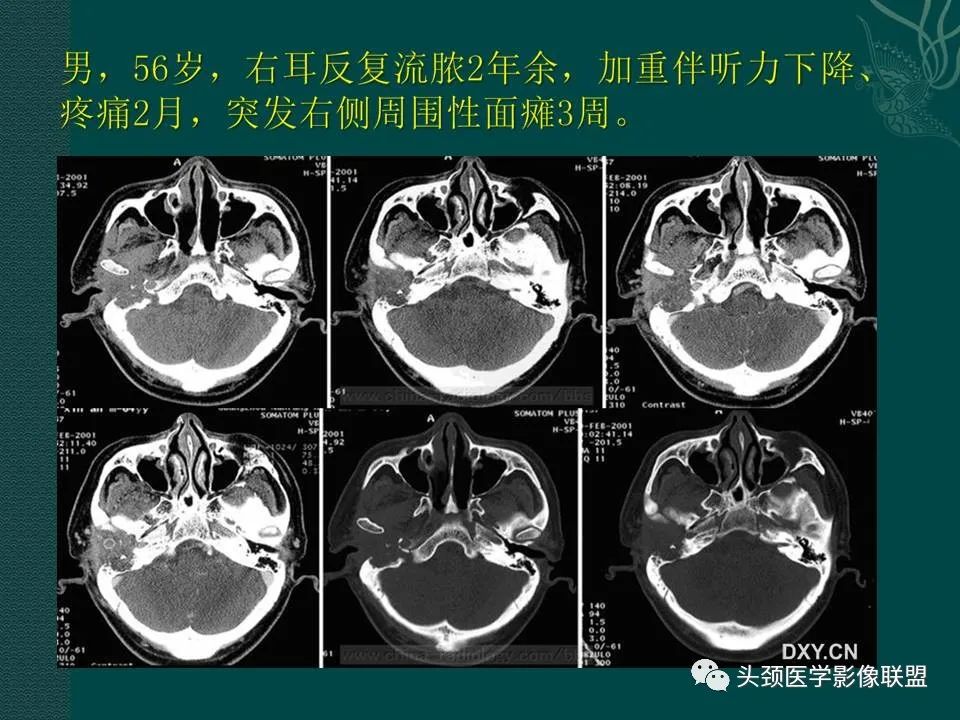 【PPT】耳部常见疾病影像表现-47