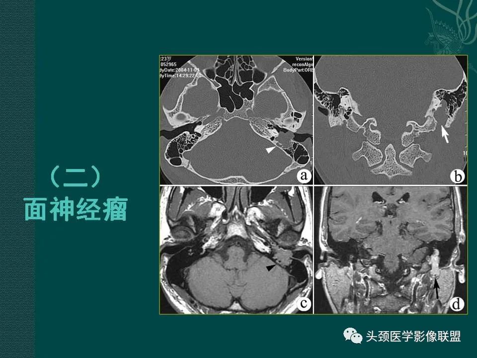 【PPT】耳部常见疾病影像表现-49