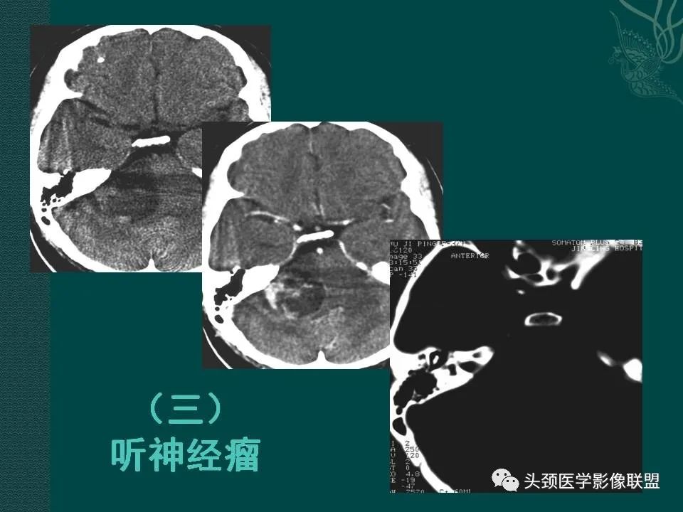 【PPT】耳部常见疾病影像表现-51